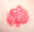 血管腫