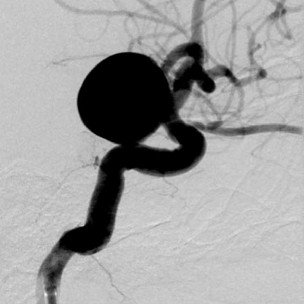 脳動脈瘤　コイル塞栓術前