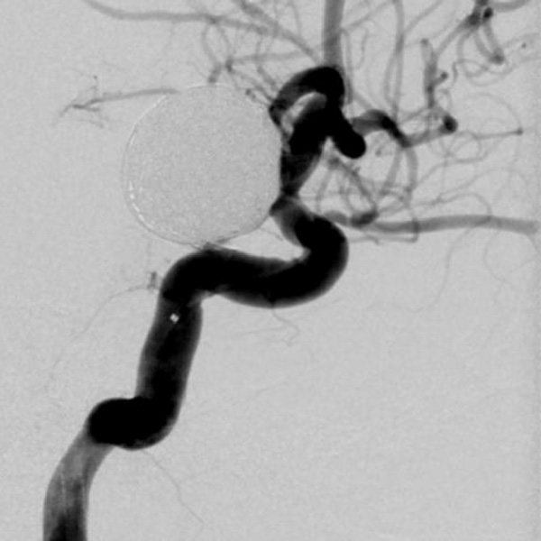 脳動脈瘤　コイル塞栓術後