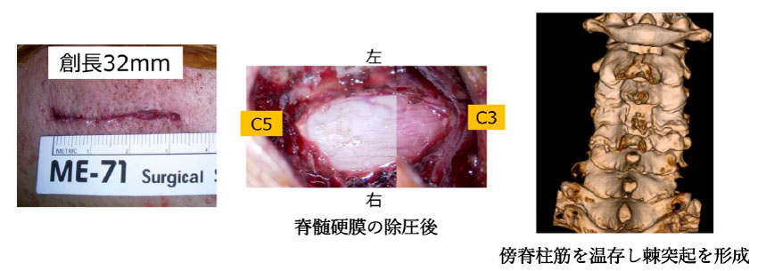 ①白石法（筋温存選択的椎弓切除）