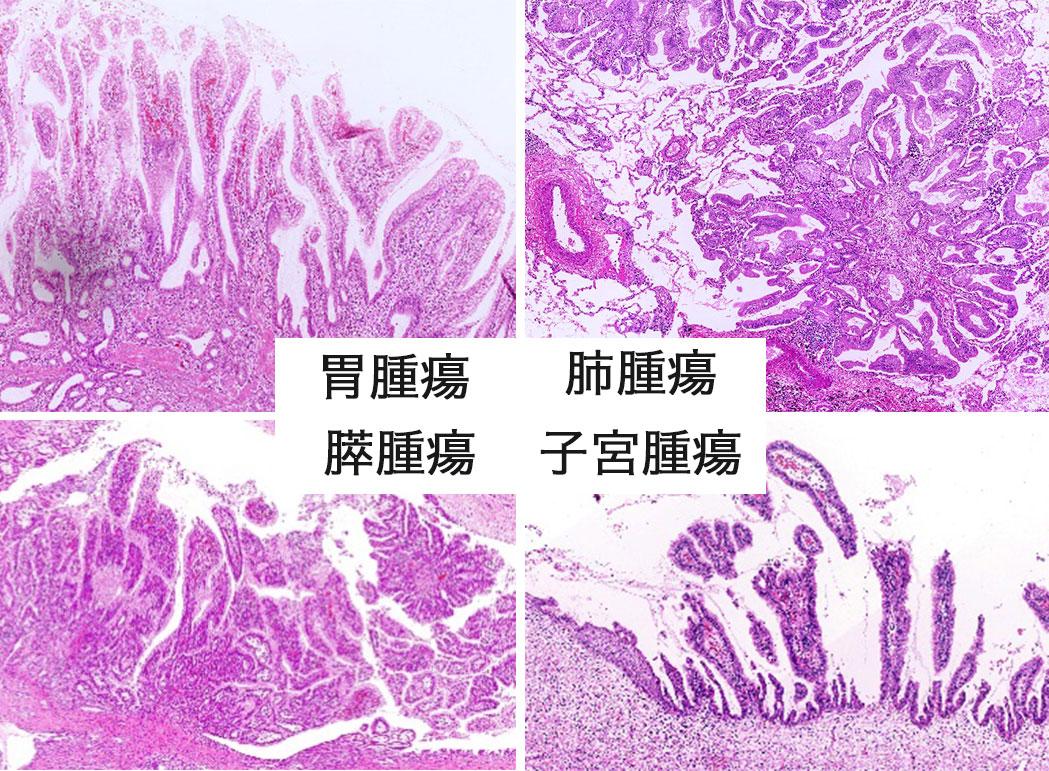 腫瘍.JPG