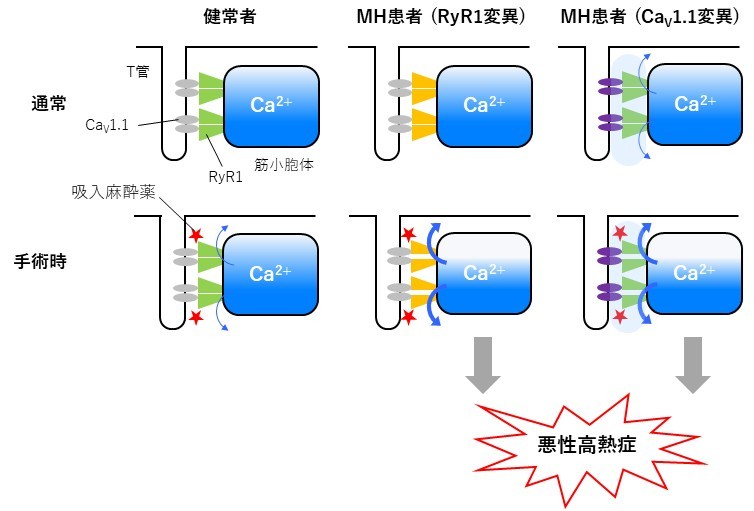 手術時に発症する難治性疾患の新たな原因を解明</br>～CaV1.1変異によるDICR亢進が悪性高熱症を誘導～