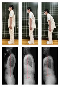 図： 検査によって評価された脊柱の姿勢。左は脊柱の前後バランスがとれた姿勢で、中央と右は上半身が骨盤に対して前方に出ており、重心が前方化している。高齢になると重心は前方に移動する傾向がある。これを評価することにより、認知機能の軽度低下を検出することが可能。