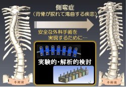 安全・安心な医療技術を実現する、 整形外科疾患の手術シミュレーション