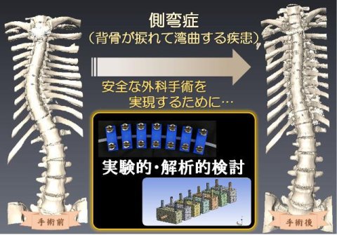 安全・安心な医療技術を実現する、 整形外科疾患の手術シミュレーション